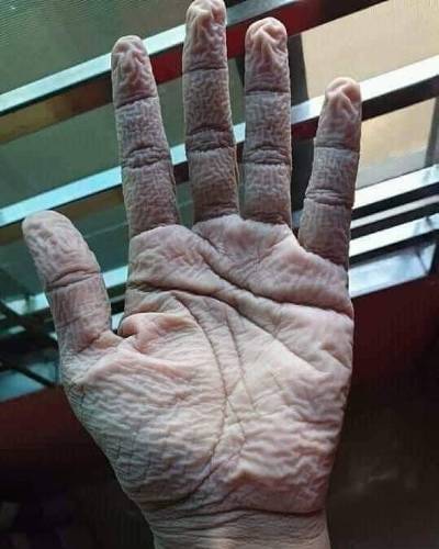 Մի քանի ամիս ձեռնոց կրած բուժաշխատողի ձեռքը. խնայեք նրանց, նրանք դեռ շատ կյանքեր ունեն փրկելու